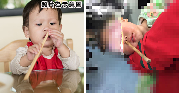 女孩玩筷子不慎從鼻穿過！急診女醫生：別放任邊