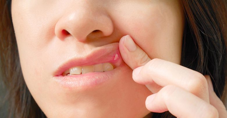 嘴破逾2週恐是癌症前兆？