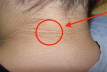 脖子卡黑垢洗不掉，「黑棘皮症」有什麼風險？