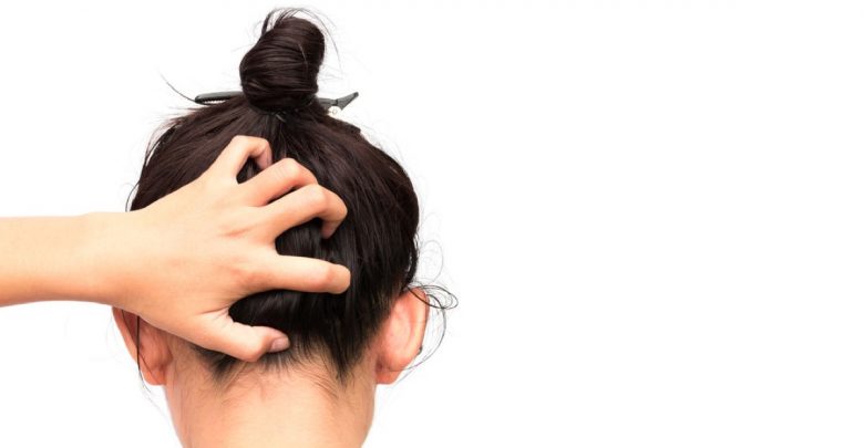 脂漏性皮膚炎的治療與控制,搔癢、脫屑好難受