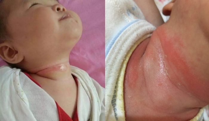 寶寶脖子老是濕濕紅紅?「淹脖子」怎麼辦?