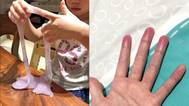 家長注意！女童玩「史萊姆」指紋消失，手指腫的像香腸