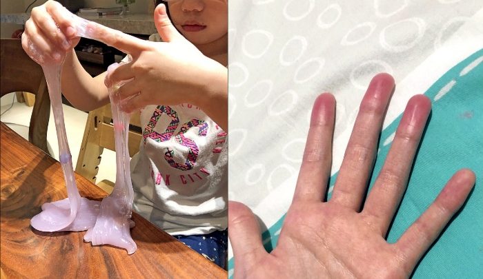 家長注意！女童玩「史萊姆」指紋消失，手指腫的像香腸