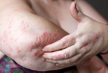 異位性皮膚炎搔癢難耐，抓到「體無完膚」小心感染蜂窩性組織炎