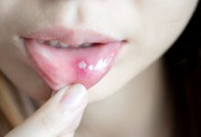 嘴巴破洞是因為「火氣大」？嘴破偏紅可能是特殊「自體免疫疾病」！