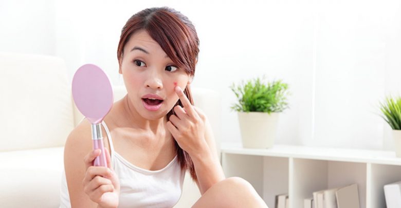 「藥戰痘」如何正確用藥，預防面皰或治療痤瘡？