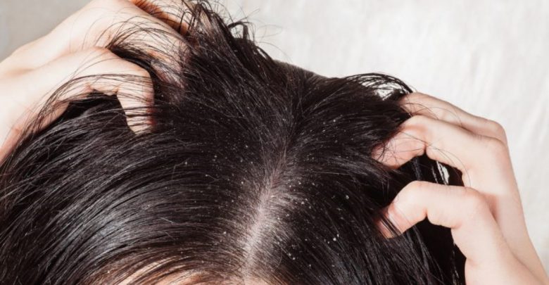 冬天頭皮又乾又癢！抗屑、生髮洗髮精真的有效嗎？