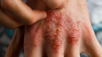 乾癬不「只」是皮膚病，全身都發炎！